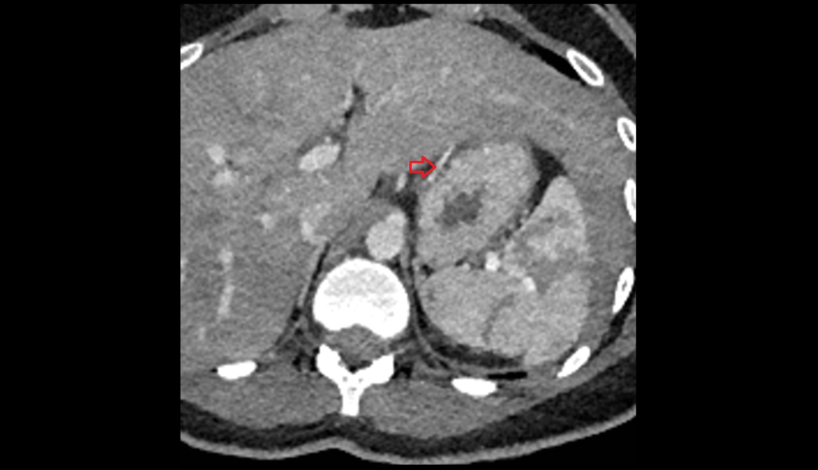 Left gastric artery ct axial