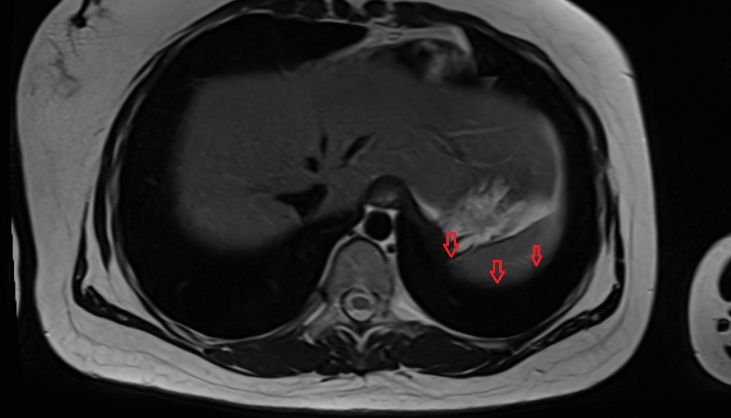 Left hemidiaphragm MRI axial  image -img-00000-00000_00001