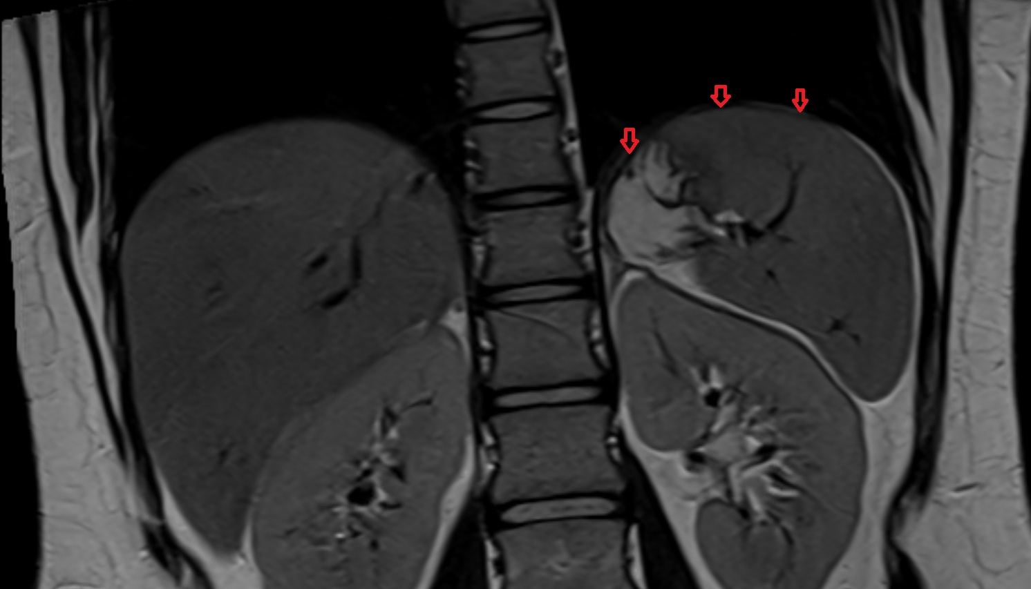 Left hemidiaphragm MRI coronal  image -img-00000-00000