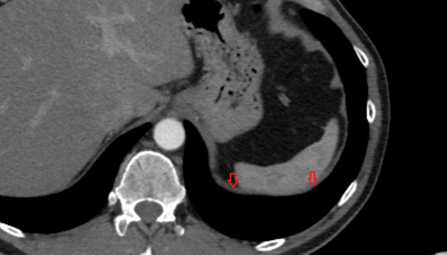 Left hemidiaphragm anatomy CT axial image -img-00000-00000