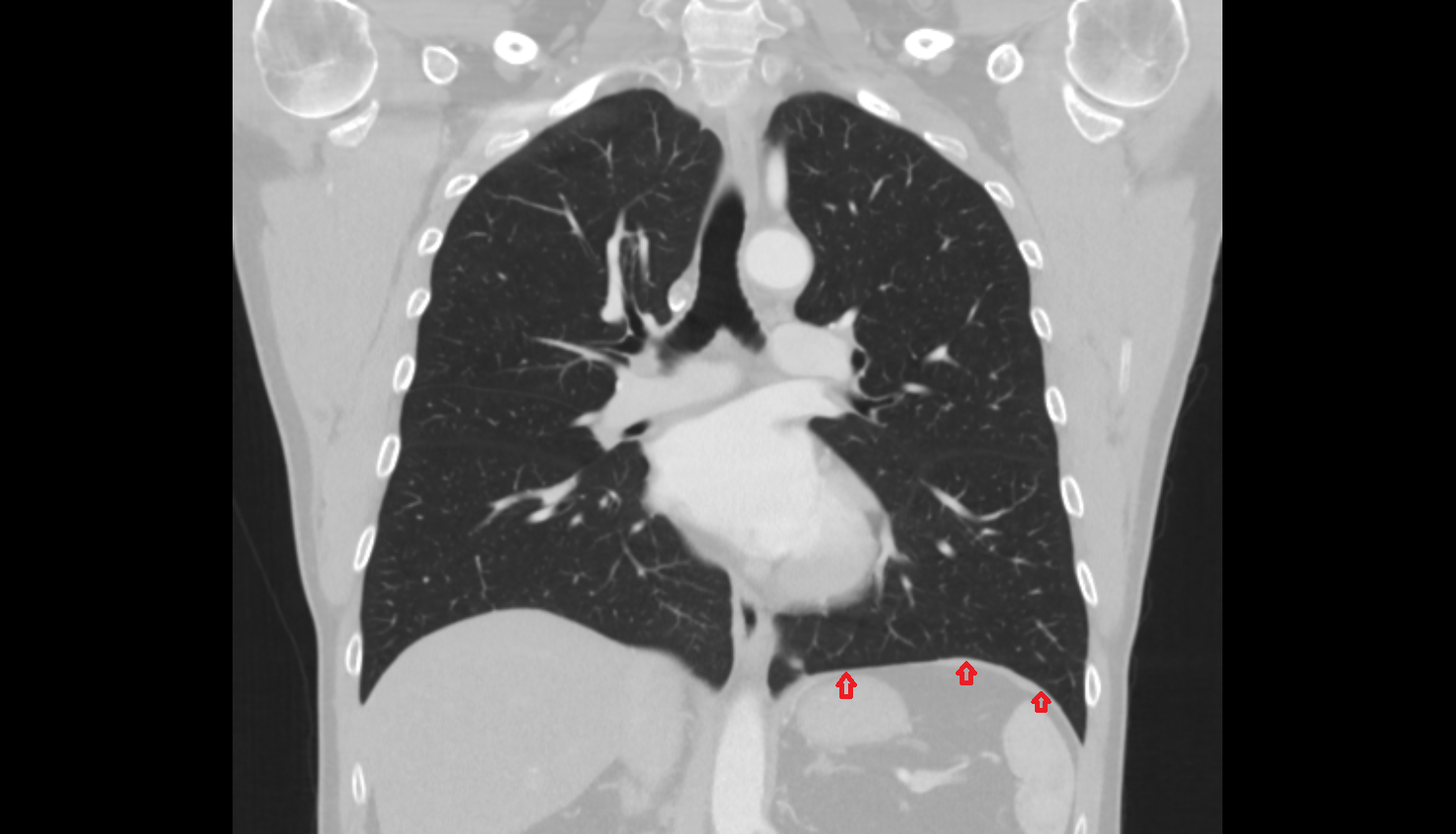 Left hemidiaphragm ct Anatomy, Location and Imaging Appearance CT anatomy image -img-00000-00000