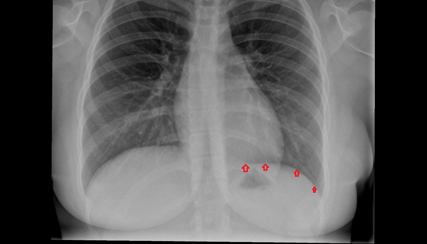 Left hemidiaphragm x ray Anatomy, Location and Imaging Appearance CT anatomy image -img-00000-00000