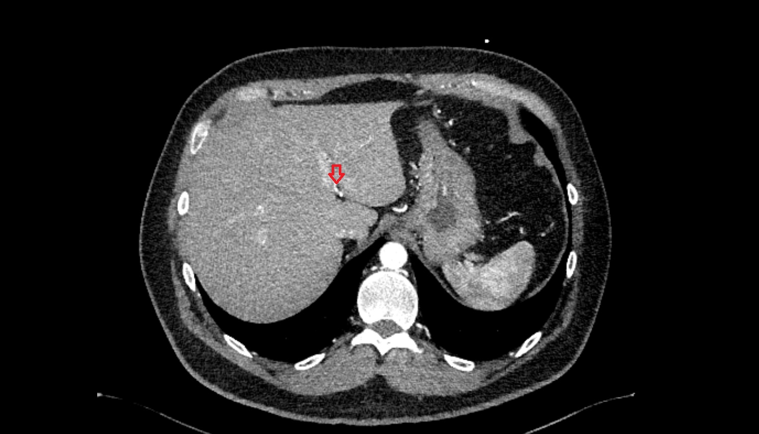 Left hepatic artery anatomy ct axial   image -img-00000-00000