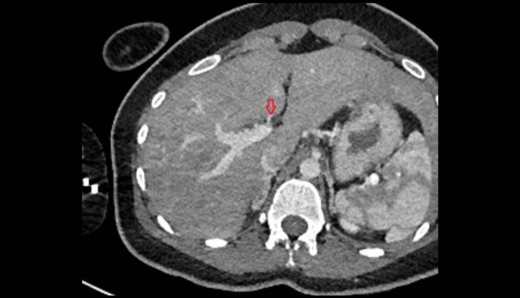 Left hepatic artery ct axial image