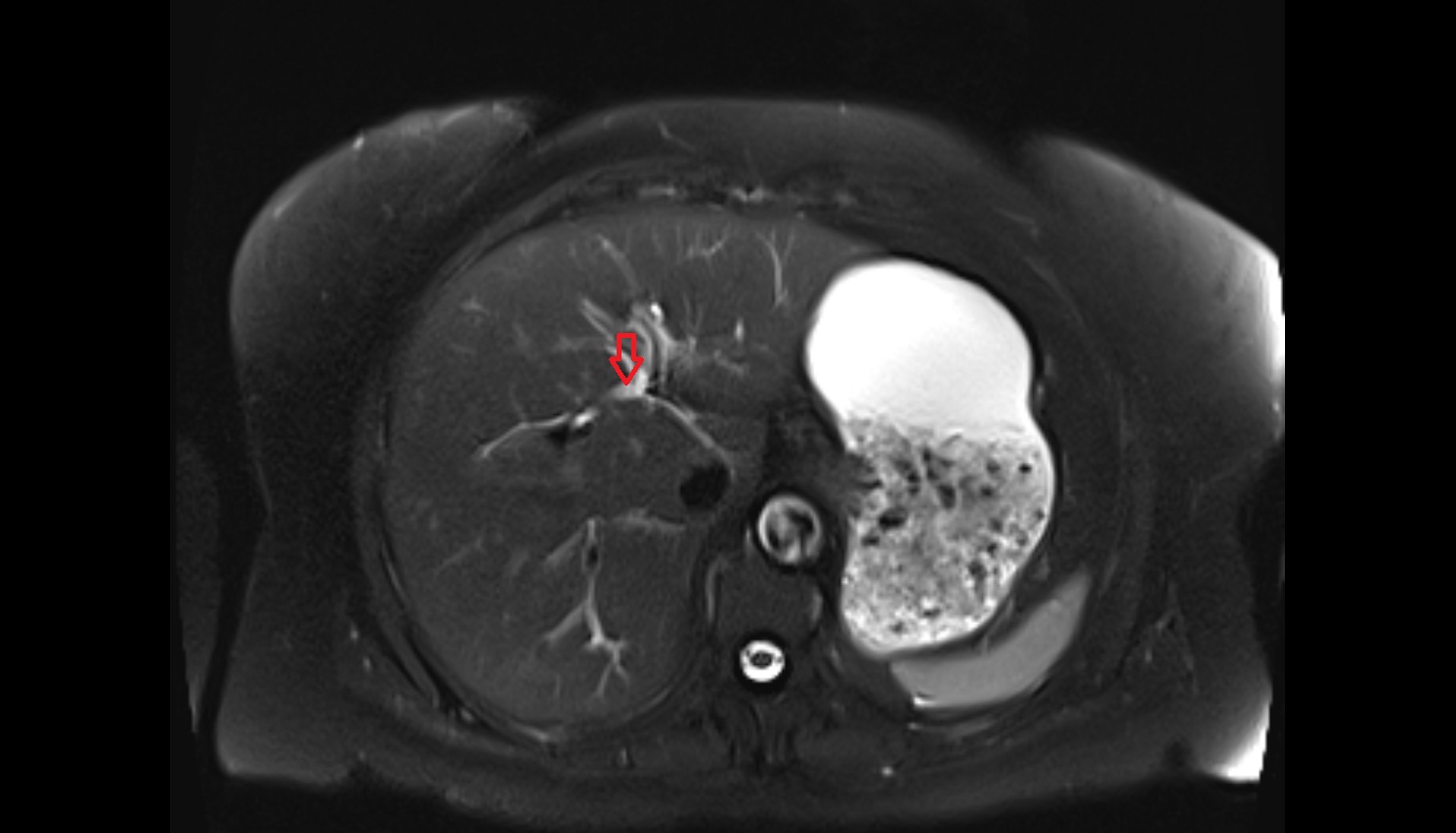 Left hepatic duct  mri  axial   anatomy  image-img-00000-00000