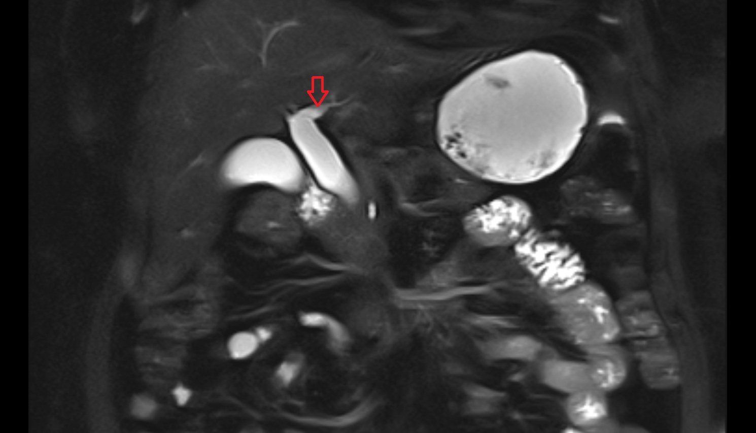 Left hepatic duct  mri  coronal  anatomy  image-img-00000-00000_00001