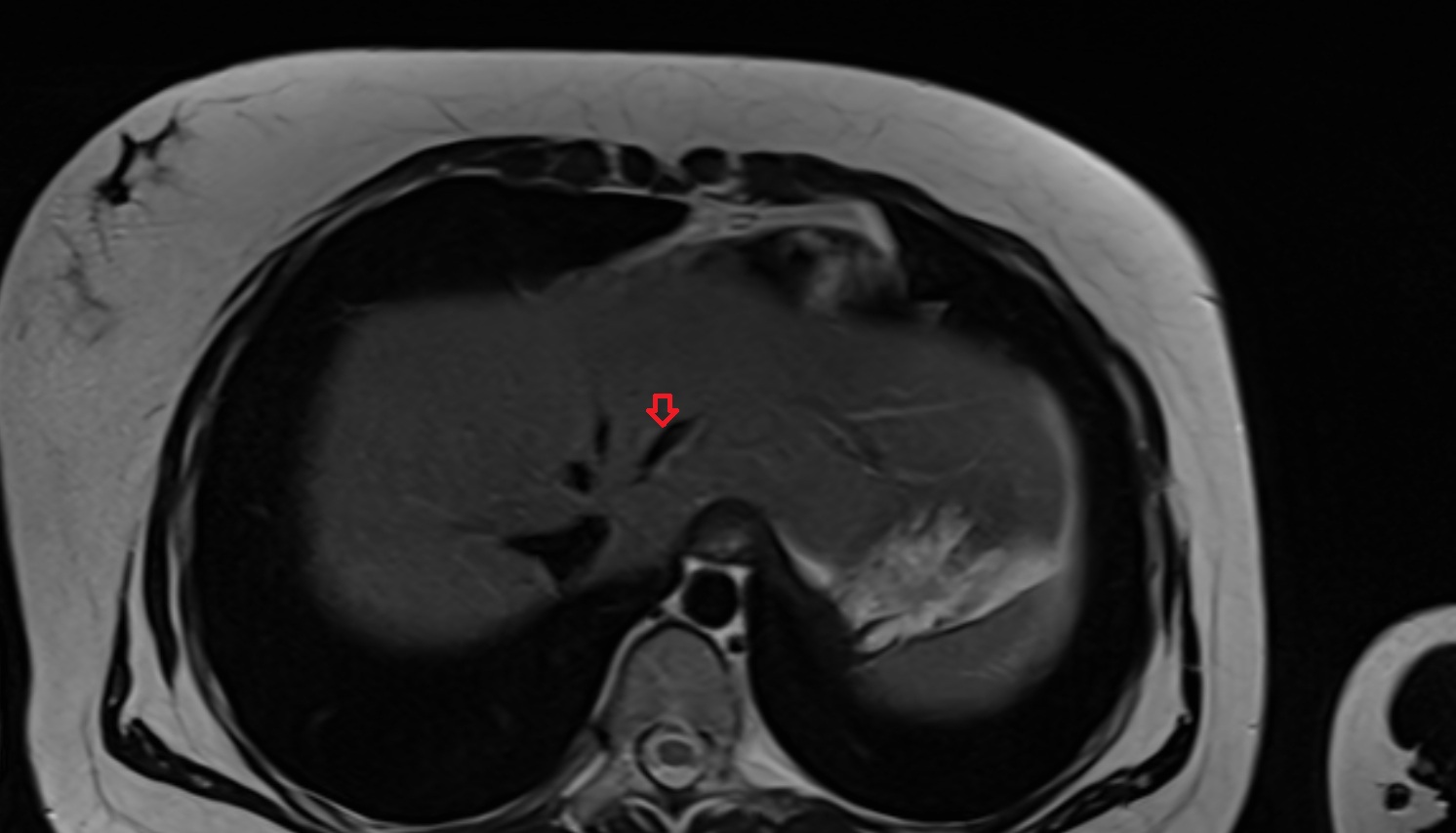 Left hepatic vein anatomy MRI axial  image -img-00000-00000