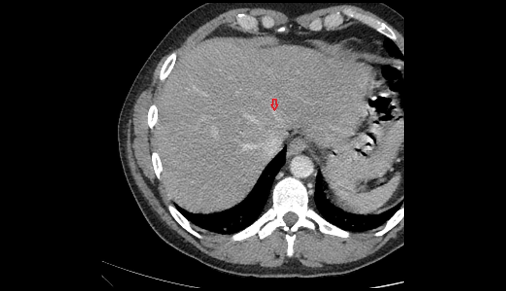Left hepatic vein ct axial