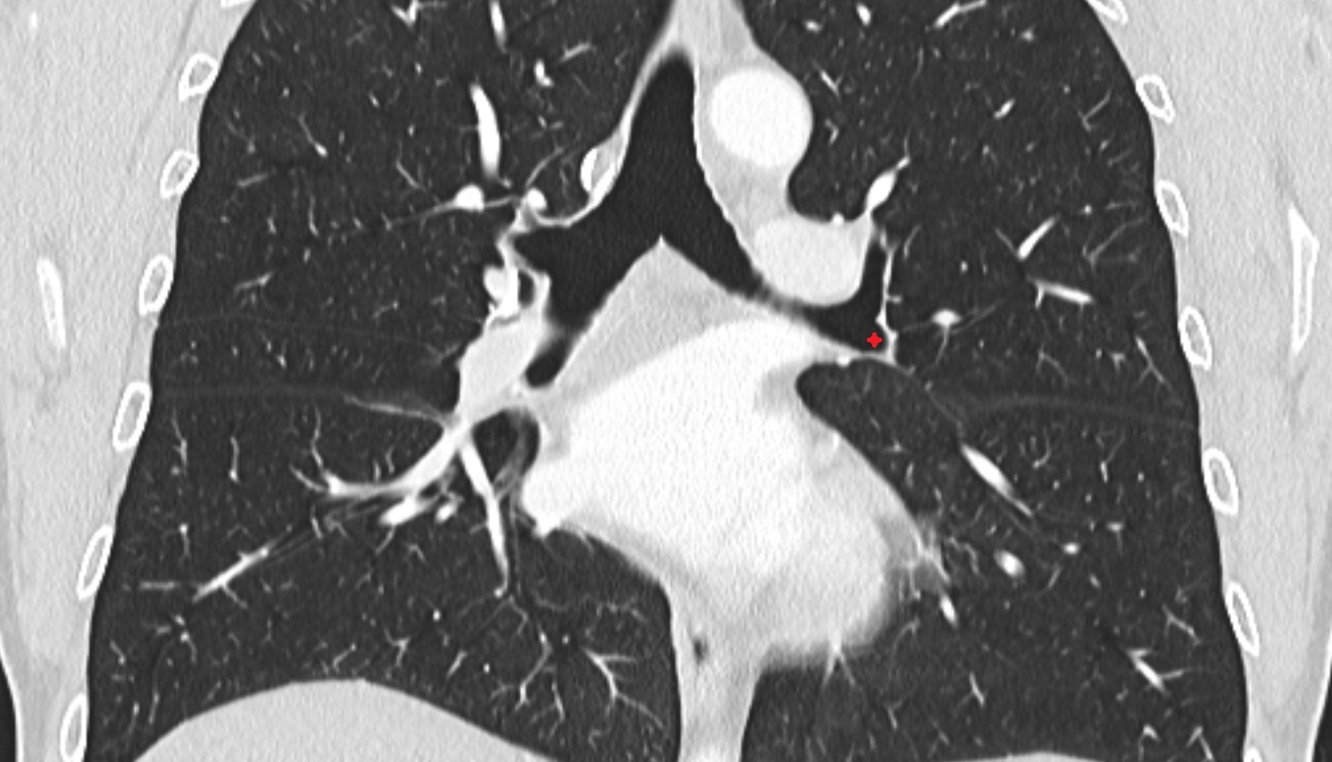 Left inferior lobar bronchus  anatomy  CT coronal  image -img-00000-00000