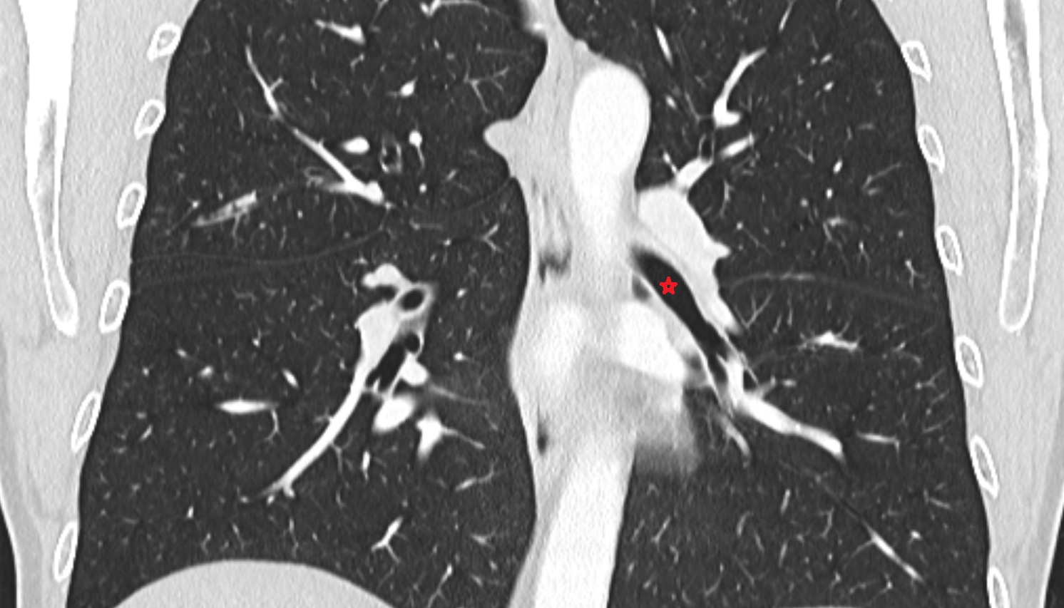 Left inferior lobar bronchus  anatomy  CT coronal  image -img-00000-00000_00002