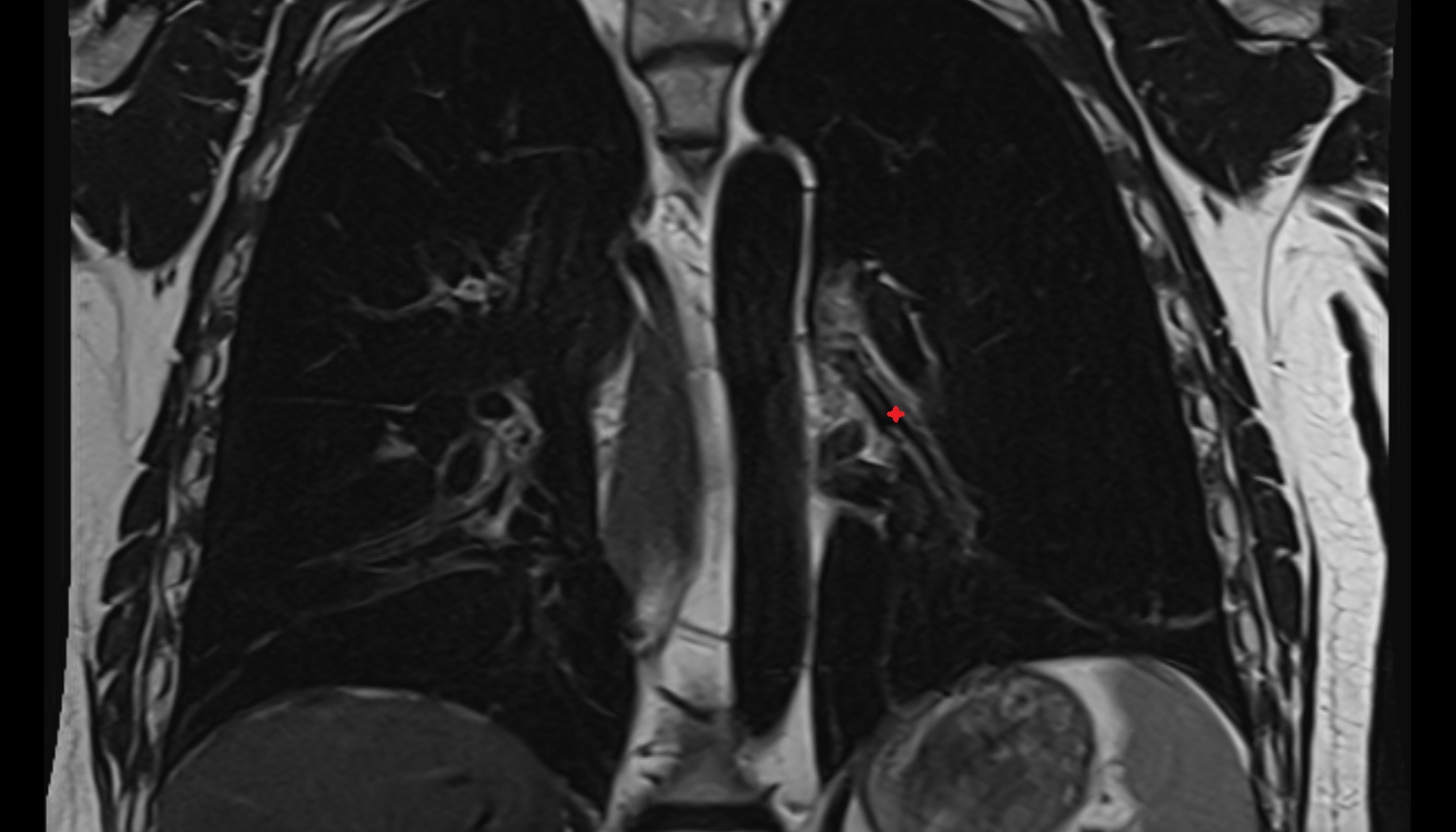 Left inferior lobar bronchus  anatomy MRI coronal  image -img-00000-00000