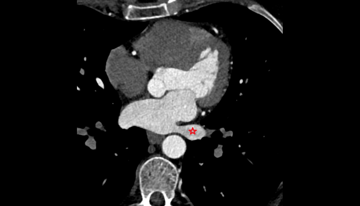 Left inferior pulmonary vein anatomy CT axial  image -img-00000-00000
