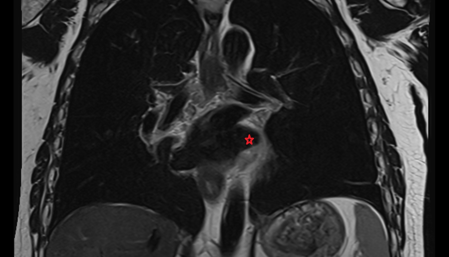 Left inferior pulmonary vein anatomy MRI coronal  image -img-00000-00000