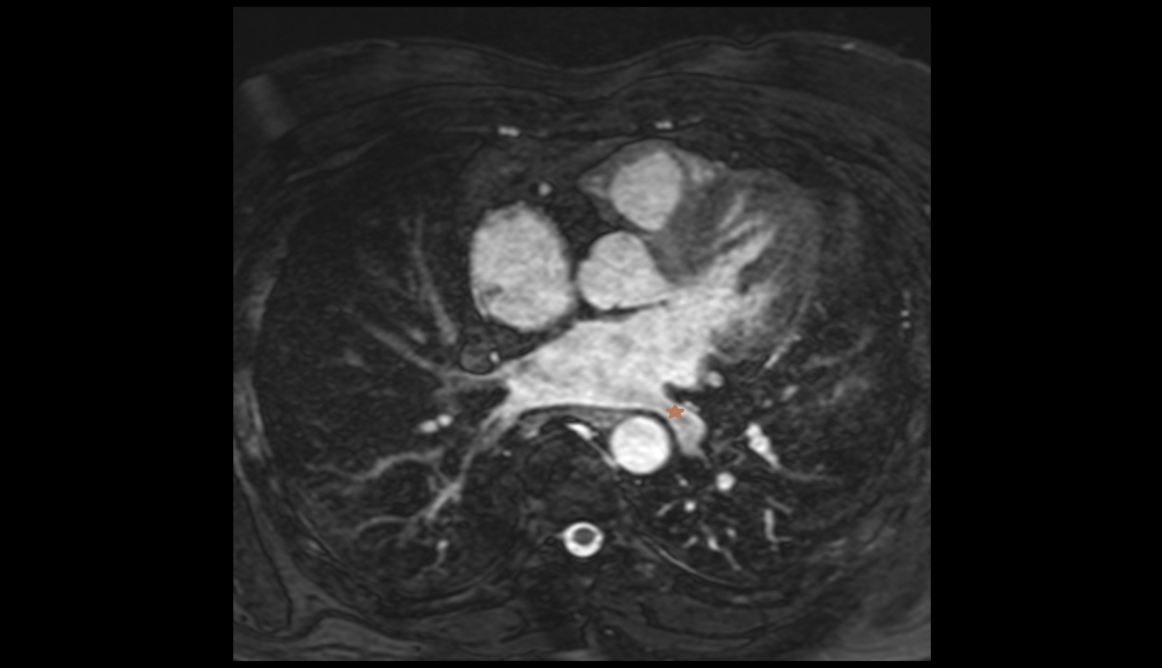 Left inferior pulmonary vein mri image