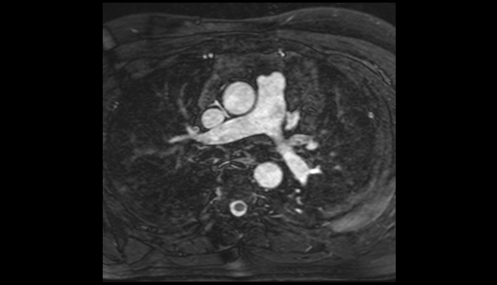 Left interlobar artery MRI IMAGE