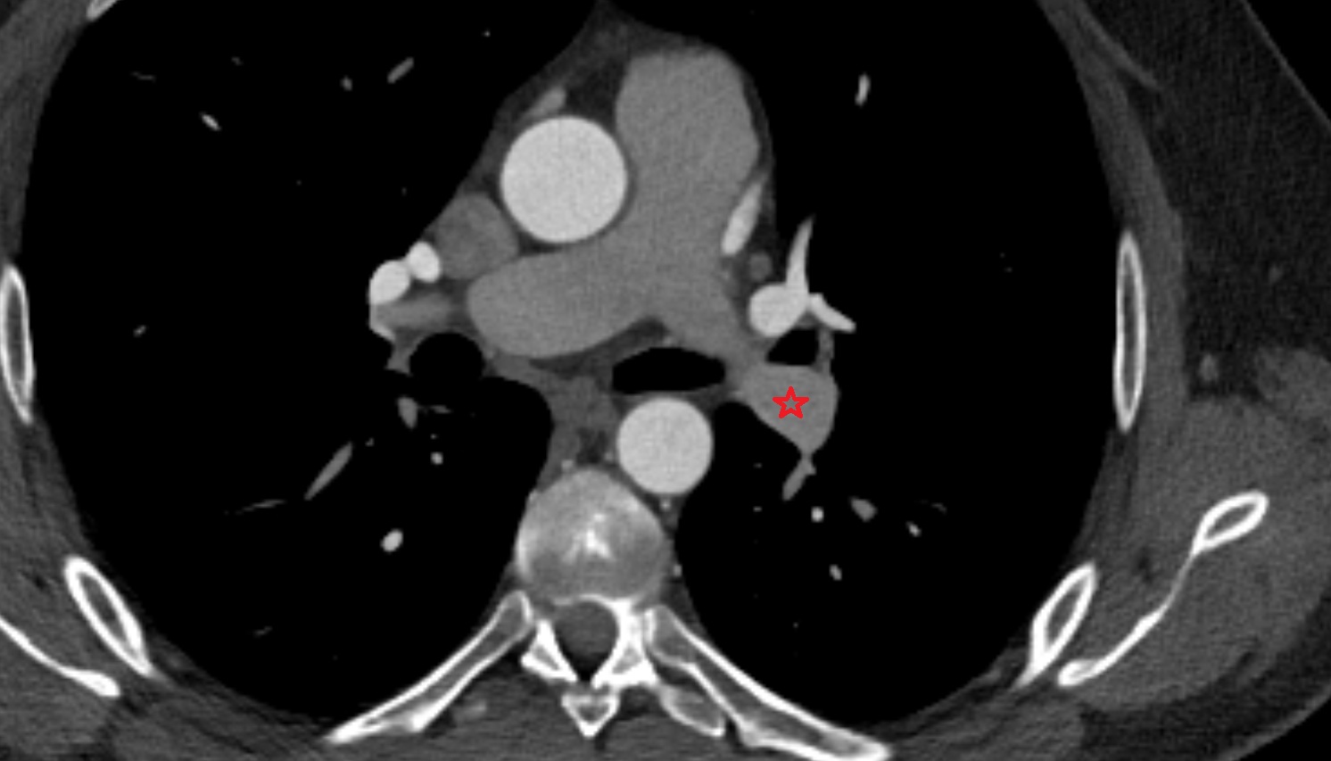 Left interlobar artery  anatomy CT axial  image -img-00000-00000