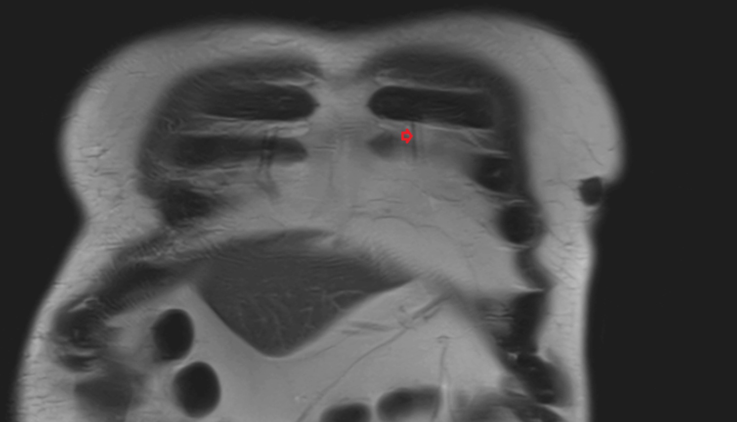 Left internal thoracic veins  MRI coronal  anatomy  image -img-00000-00000