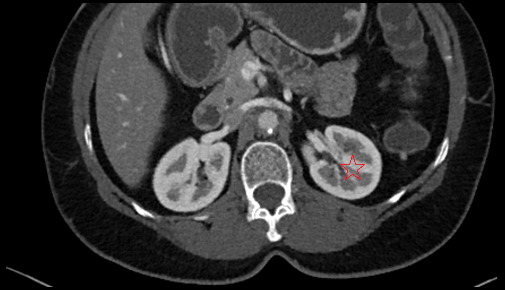 Left  kidney  CT axial image