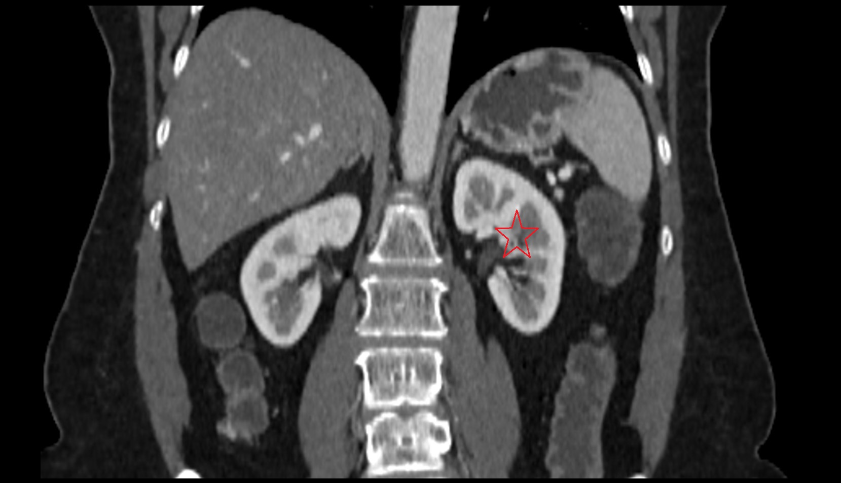 Left  kidney  CT coronal image