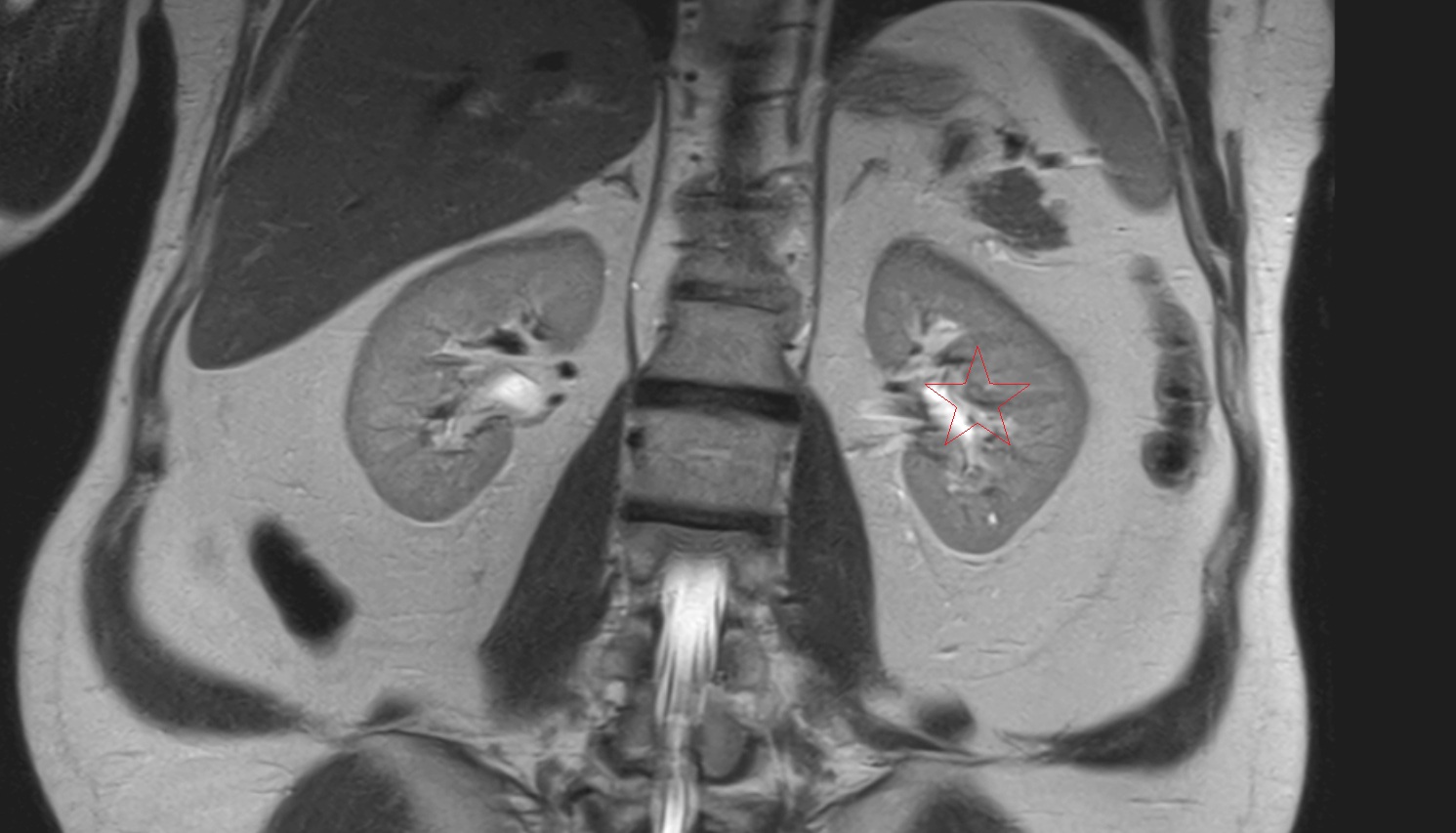 Left  kidney  MRI  coronal  image anatomy  image -img-00000-00000