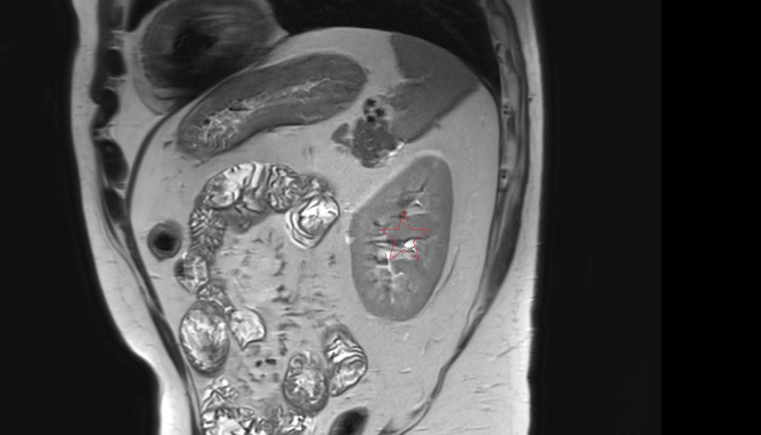 Left  kidney  MRI  sagittal  image anatomy  image -img-00000-00000