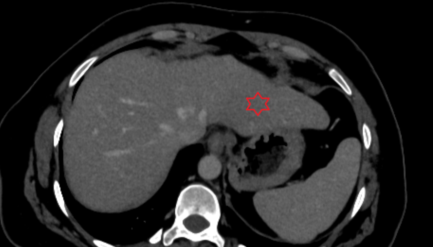 Liver left lateral inferior segment — Segment II   CT  axial  anatomy  image