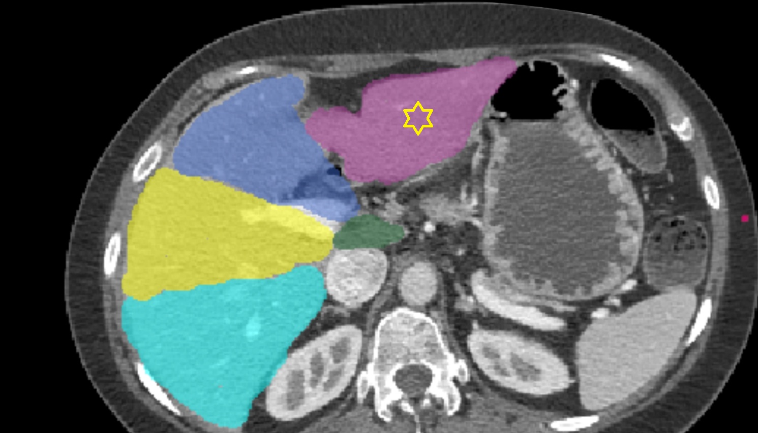 Left lateral inferior segment — Segment III  CT  axial  anatomy  image-img-00000-00000