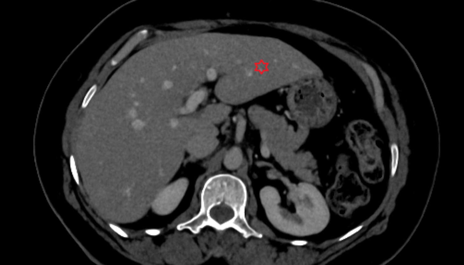 Left lateral inferior segment — Segment III  CT  axial  anatomy  image-img-00000-00000_00001