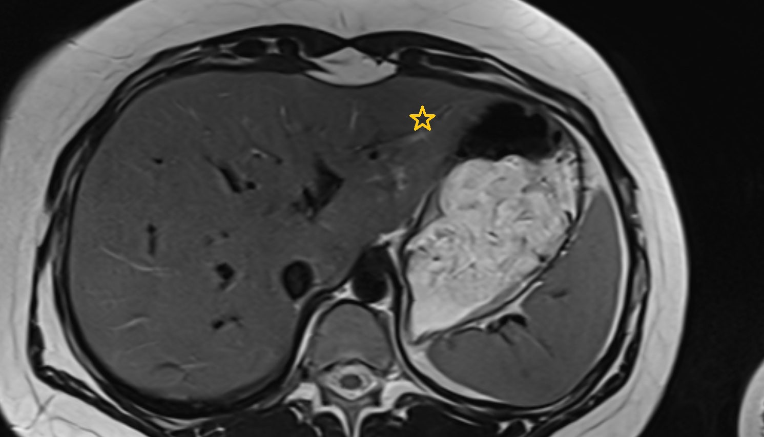 Left lateral inferior segment — Segment III  MRI  axial  anatomy  image-img-00000-00000