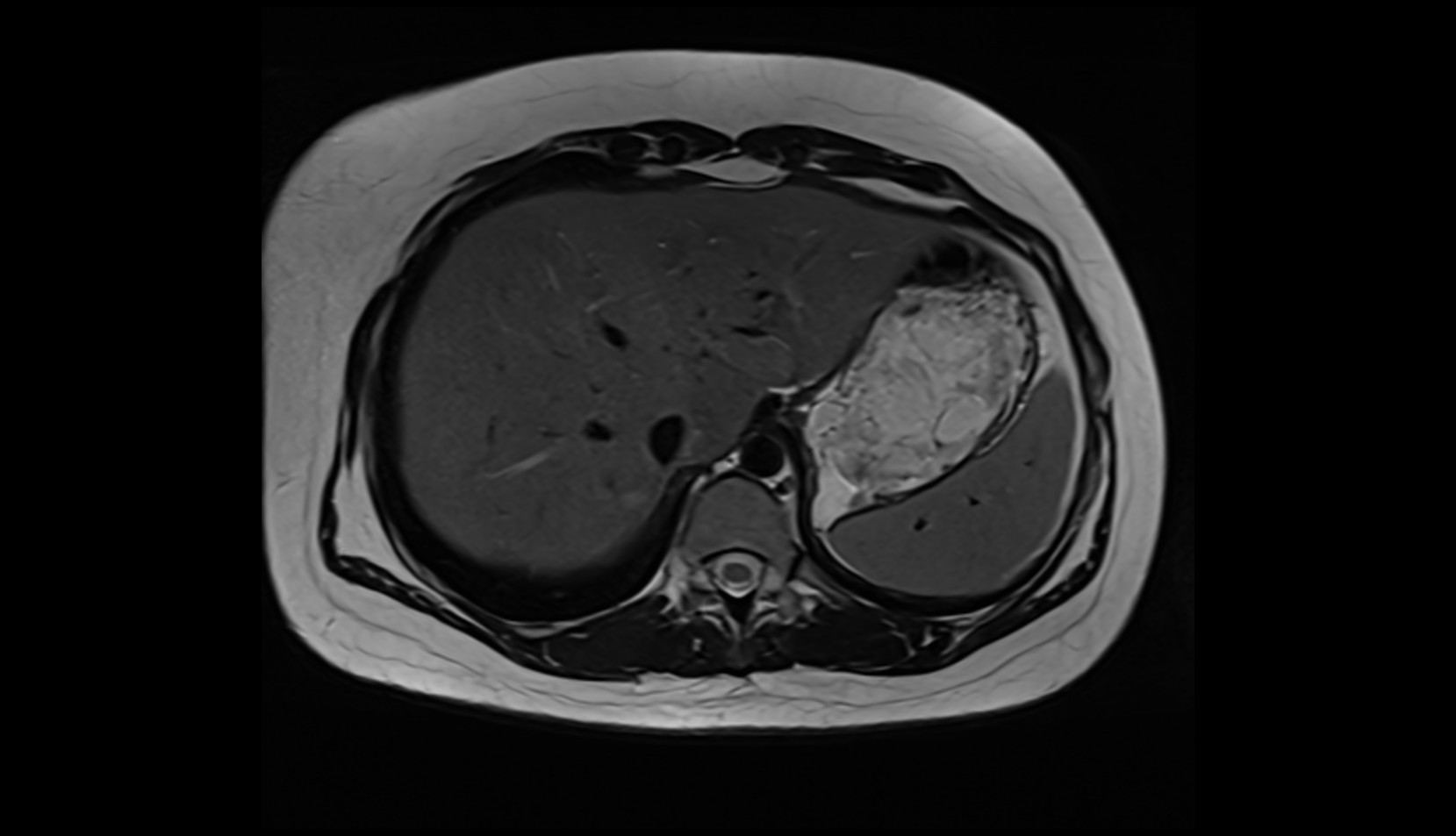 Left lobe of liver MRI AXIAL IMAGE