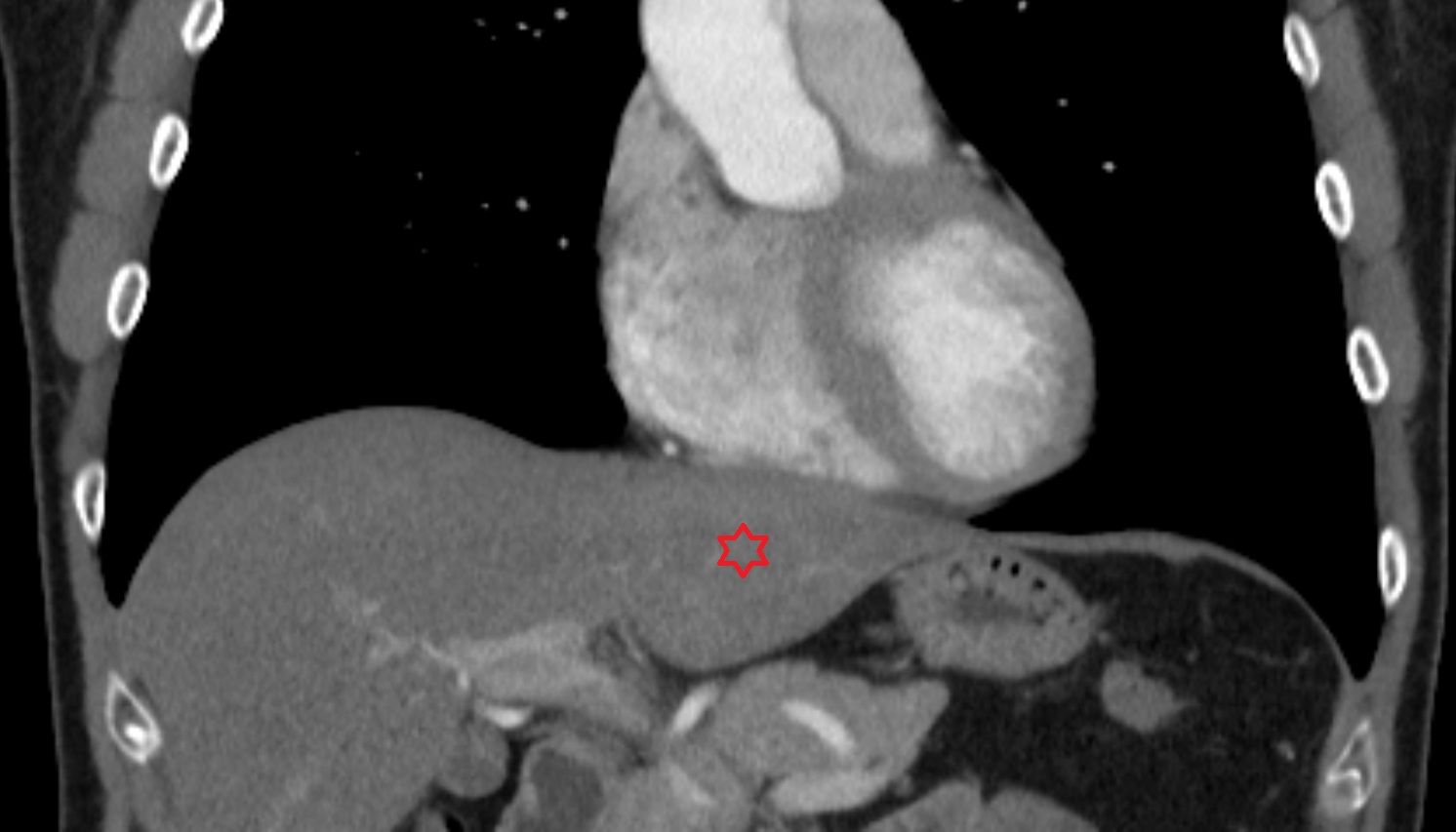 Left lobe of liver coronal CT  image -img-00000-00000_00001