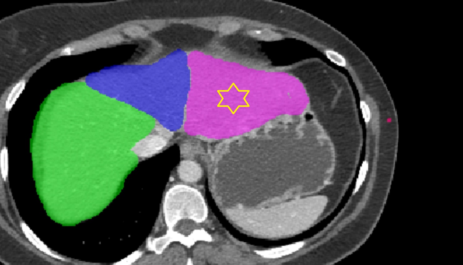 Left lobe of liver AXIAL CT  image -img-00000-00000