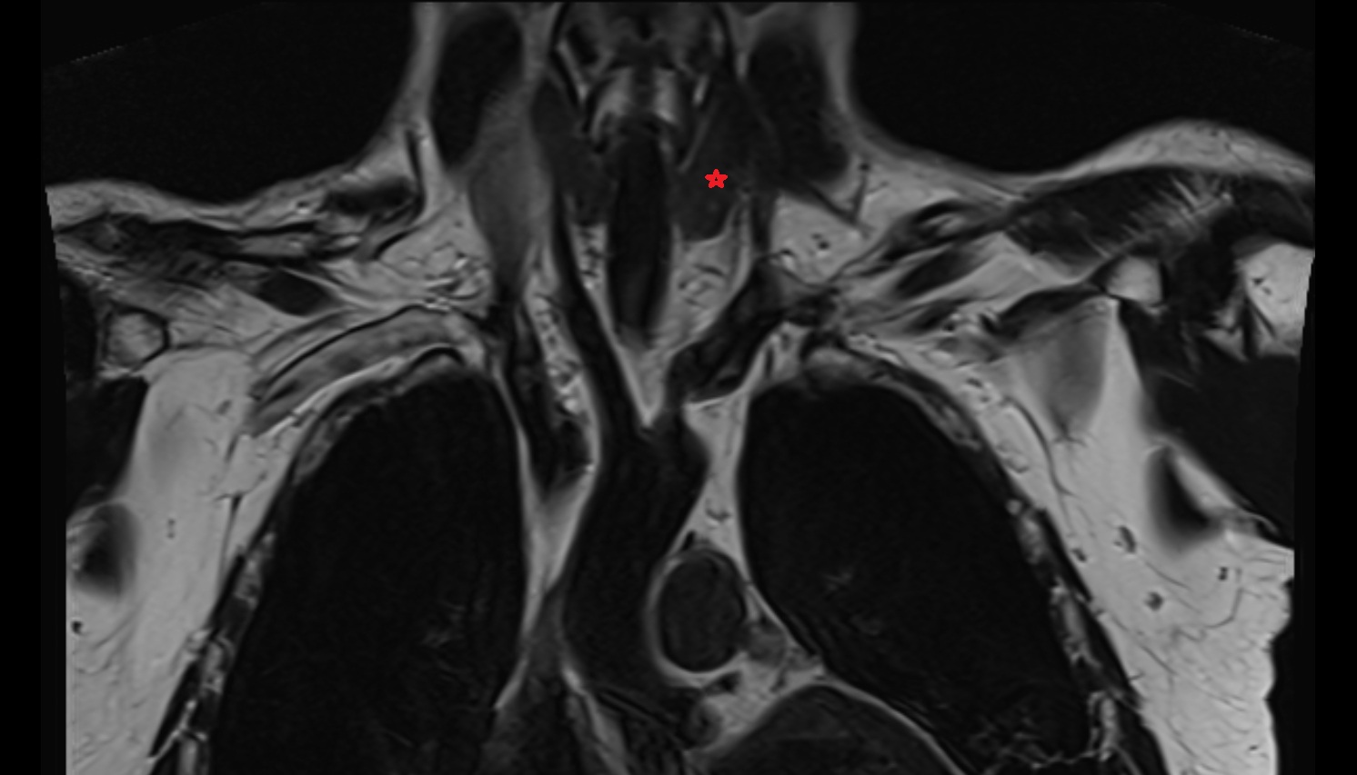 Left lobe of thyroid gland coronal MRI  image -img-00000-00000