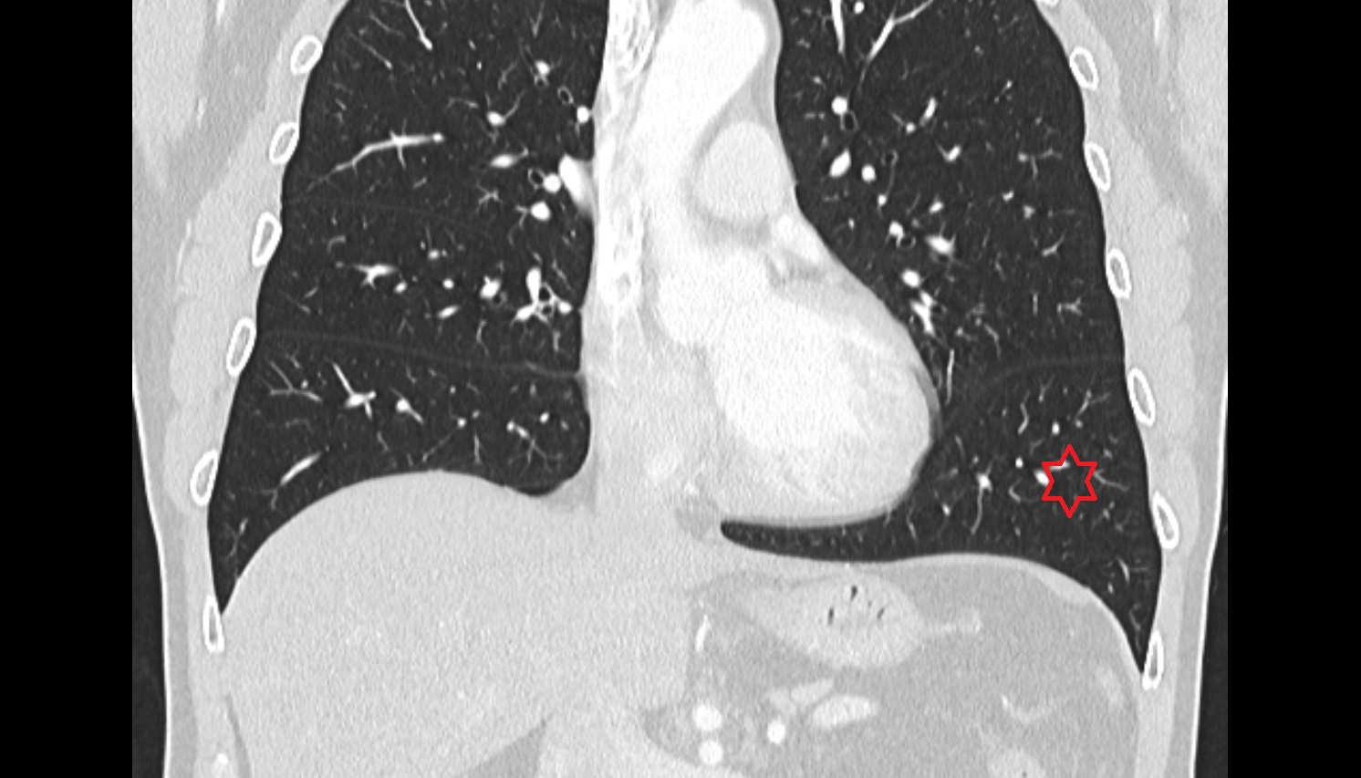 Left lung (inferior lobe)  anatomy  CT coronal  image -img-00000-00000
