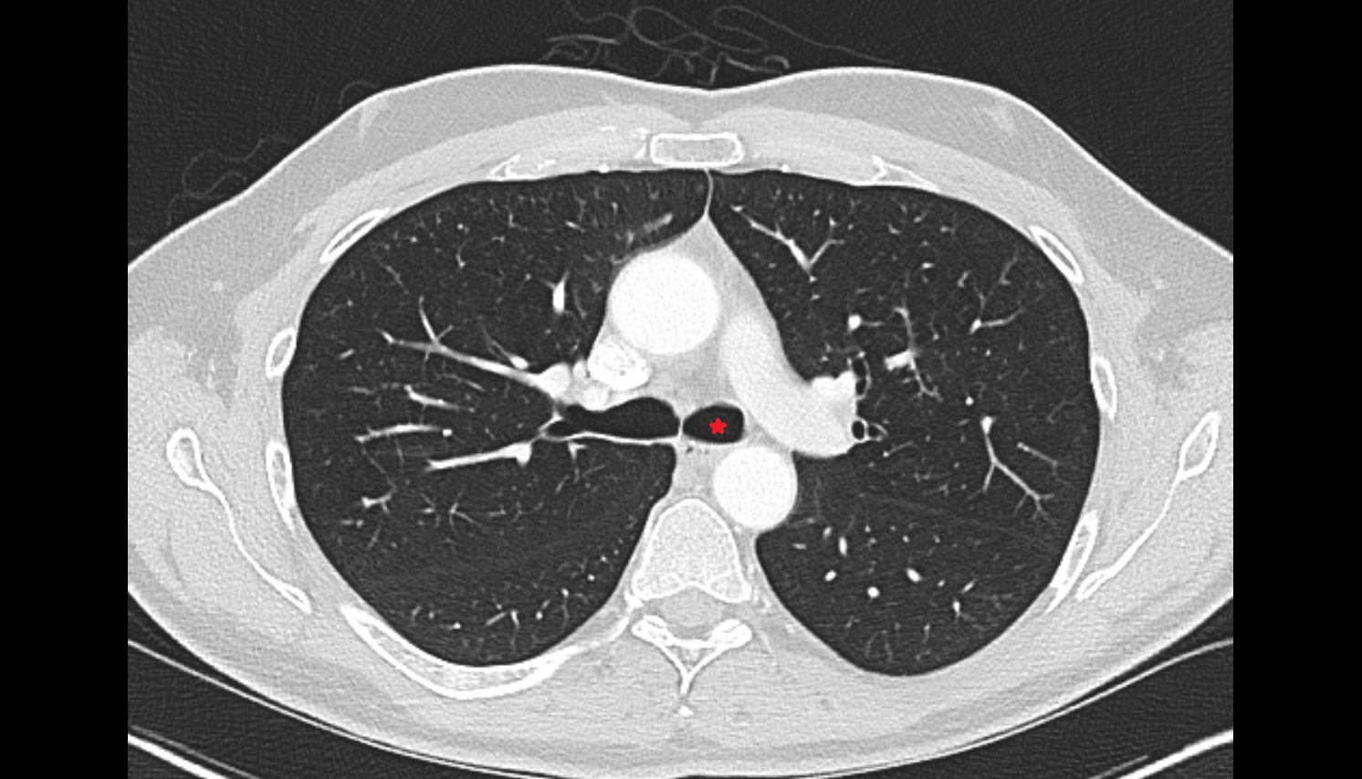 Left main bronchus  anatomy  CT axial  image -img-00000-00000_00001
