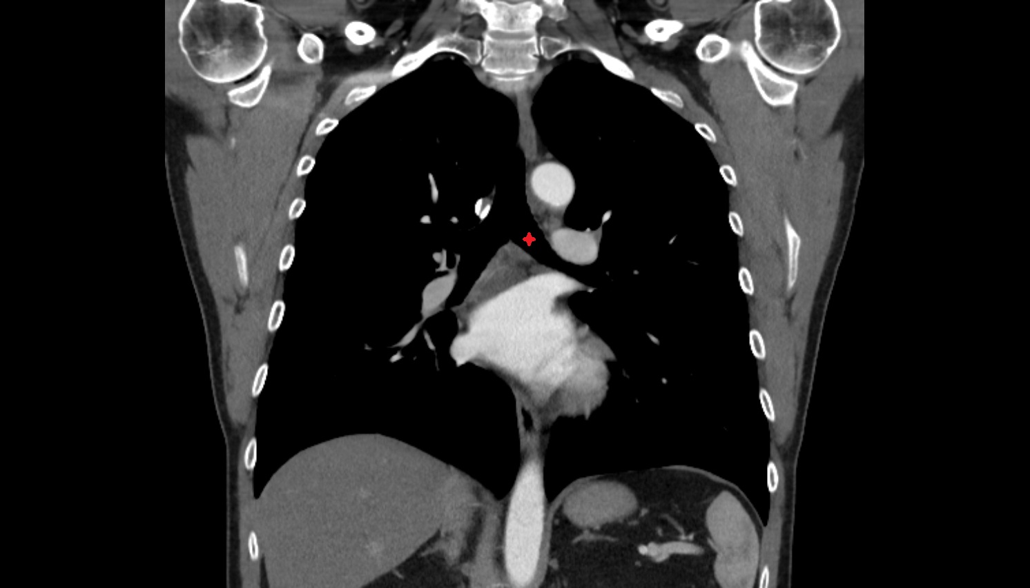 Left main bronchus  anatomy CTcoronal  image -img-00000-00000