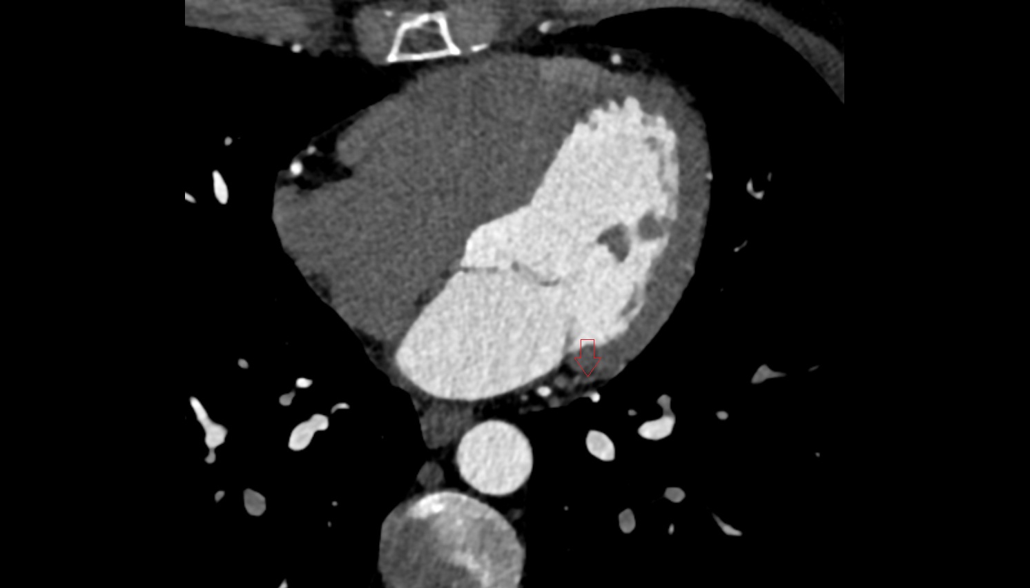 Left marginal vein  anantomy  CT  axial image -img-00000-00000_00001