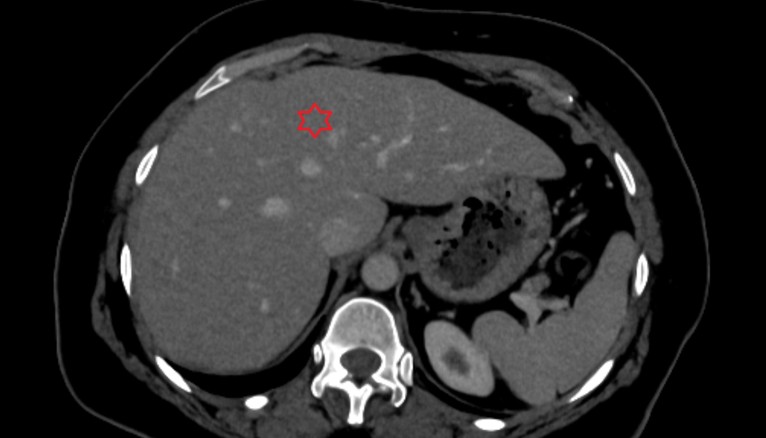 Left medial superior segment — Segment IVa  CT  axial  anatomy  image-img-00000-00000