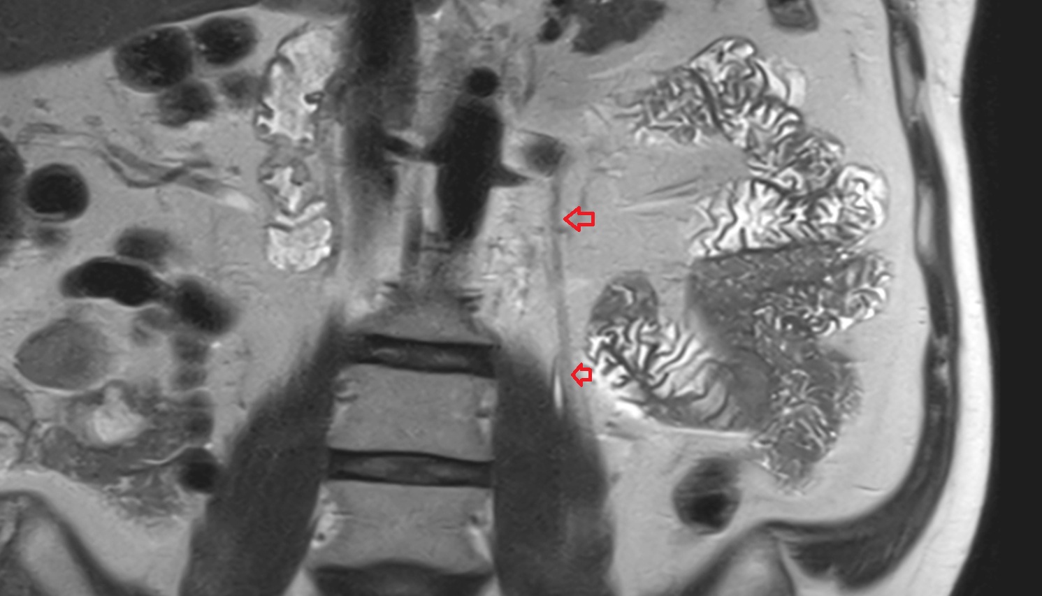 Left ovarian vein   MRI coronal  anatomy  image -img-00000-00000