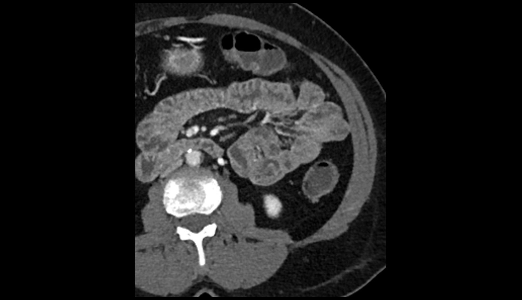 Left ovarian vein ct axial 1