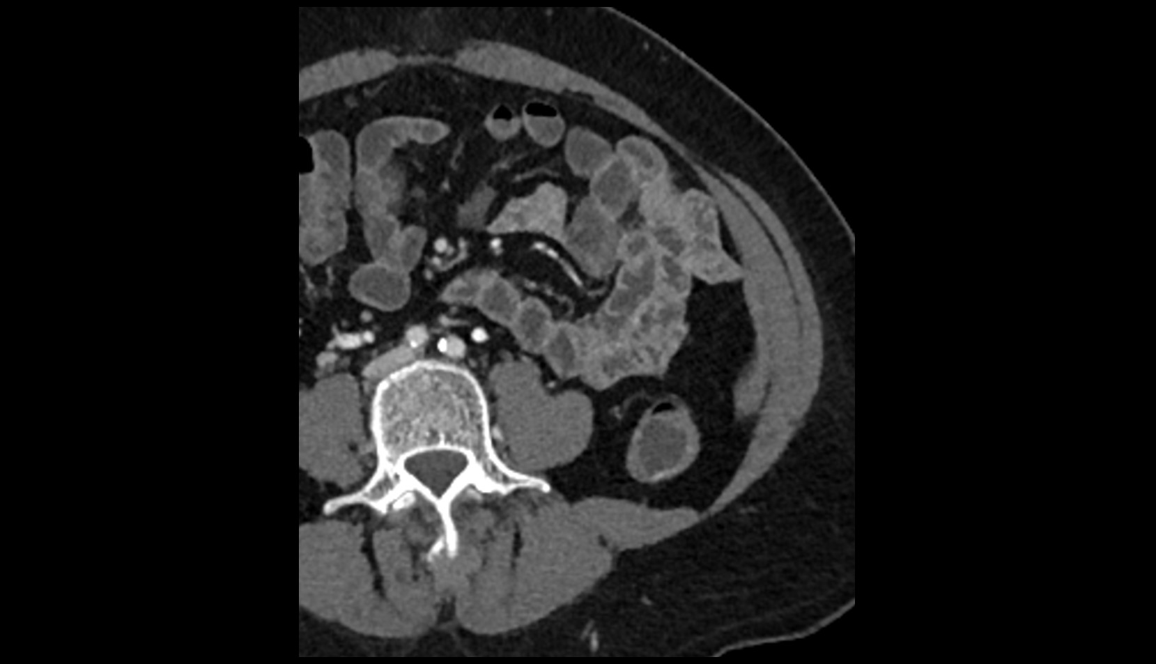 Left ovarian vein ct axial 2