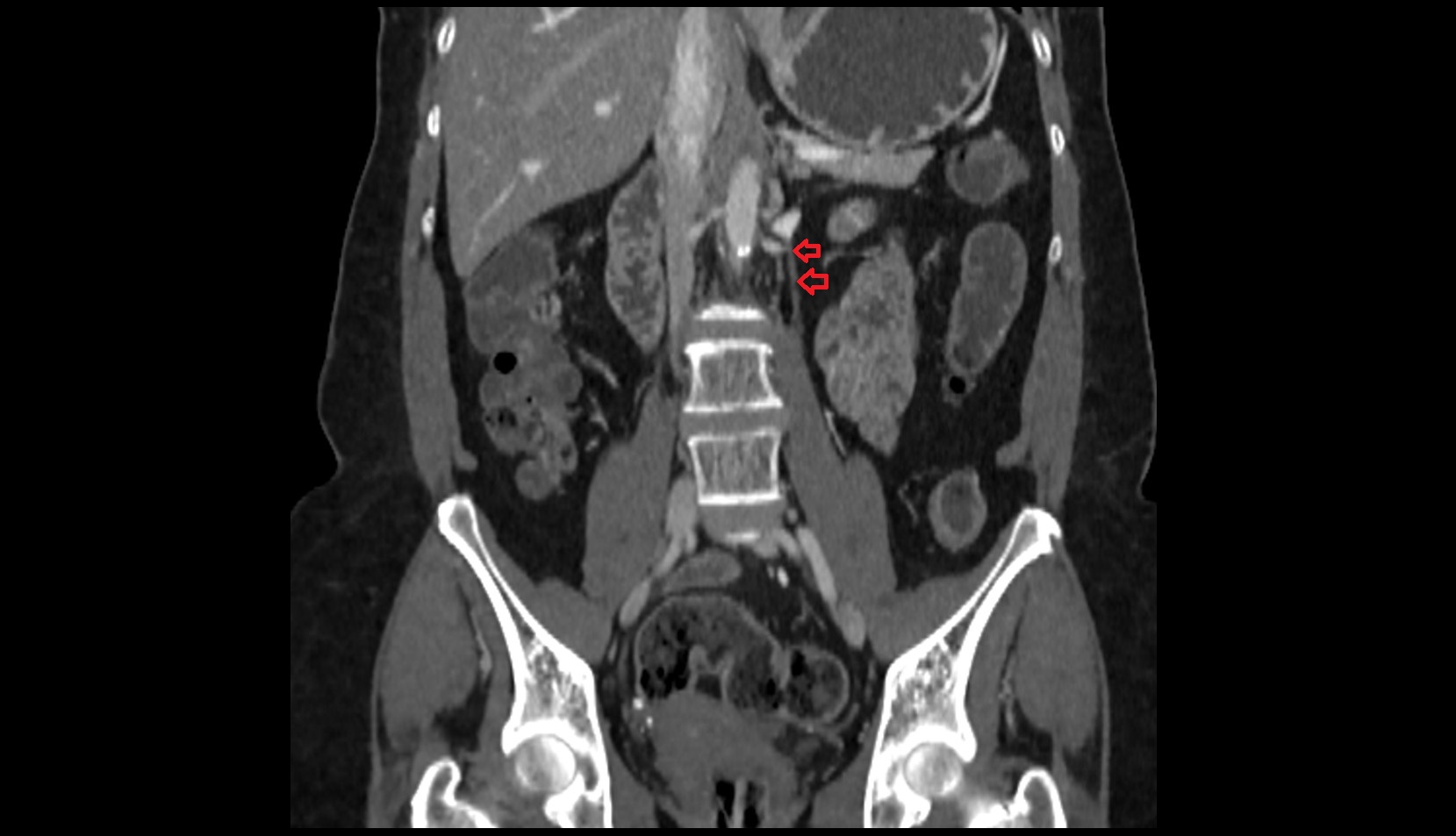Left ovarian vein ct coronal