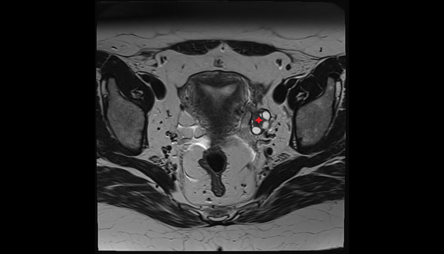 Left  ovary MRI  axial  image anatomy  image-img-00000-00000