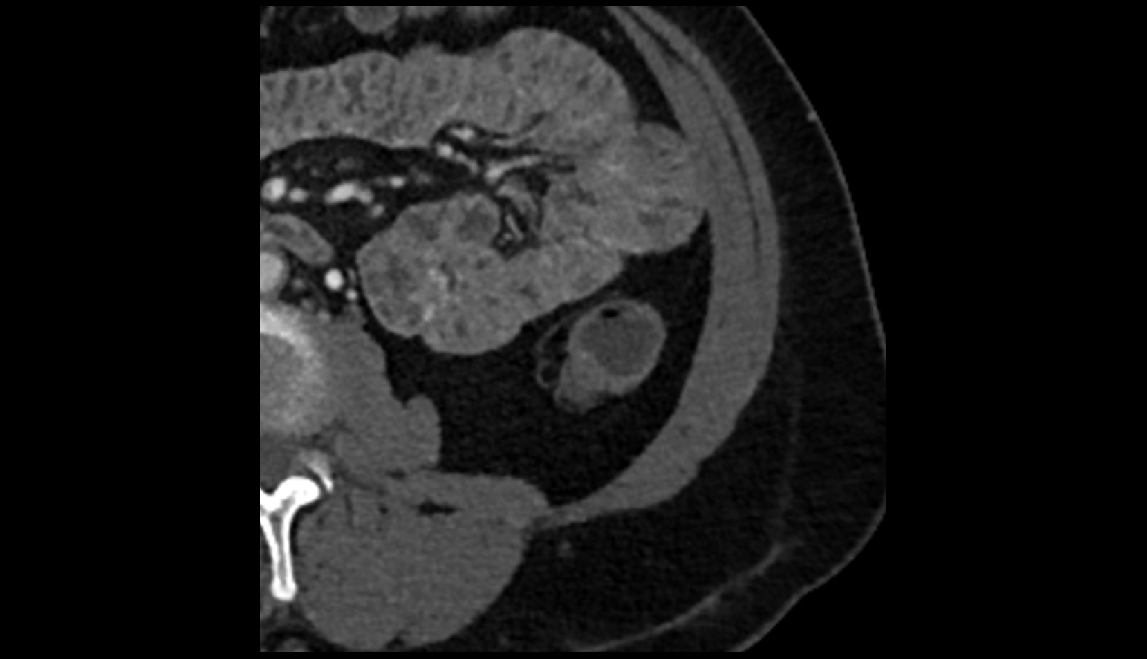 Left paracolic gutter   CT  axial image anatomy  image
