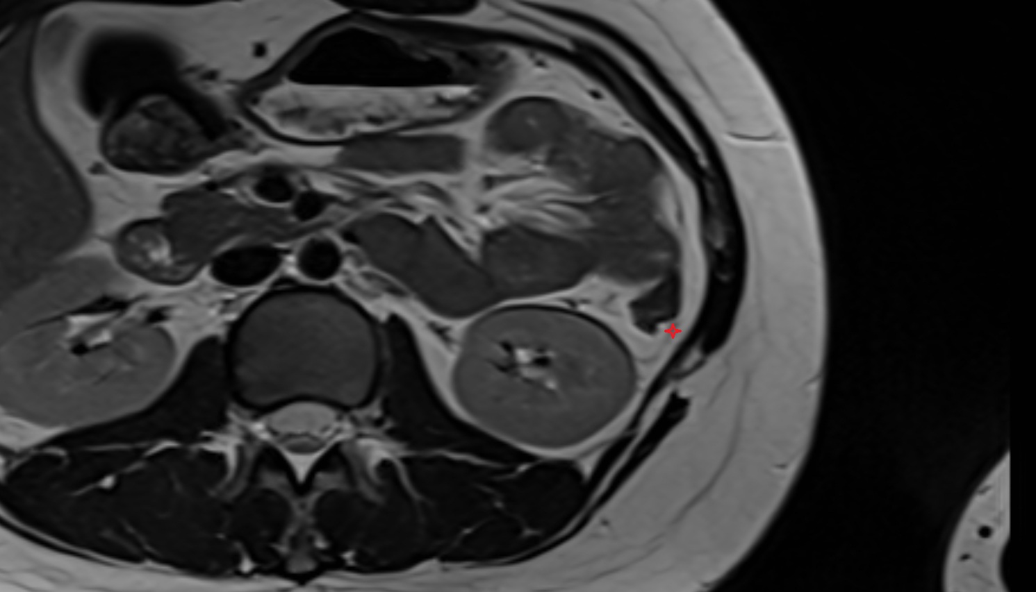 Left paracolic gutter    MRI  axial image anatomy  image -img-00000-00000
