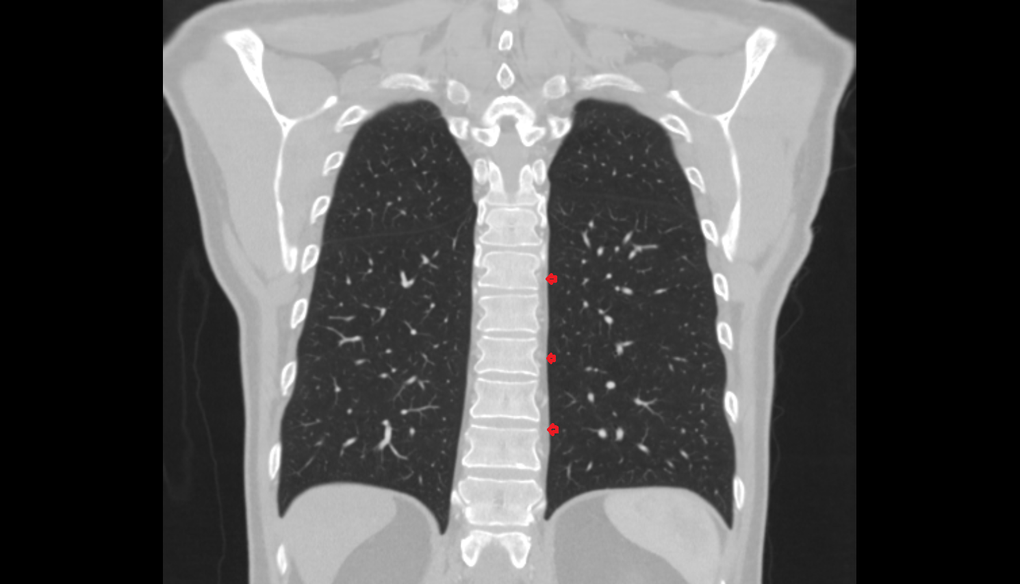 Left paraspinal line ct  Anatomy, Location and Imaging Appearance CT anatomy image -img-00000-00000