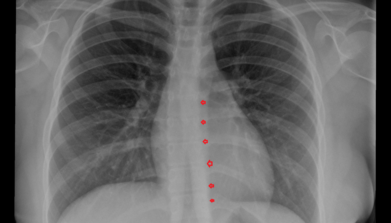 Left paraspinal line x ray  Anatomy, Location and Imaging Appearance CT anatomy image -img-00000-00000