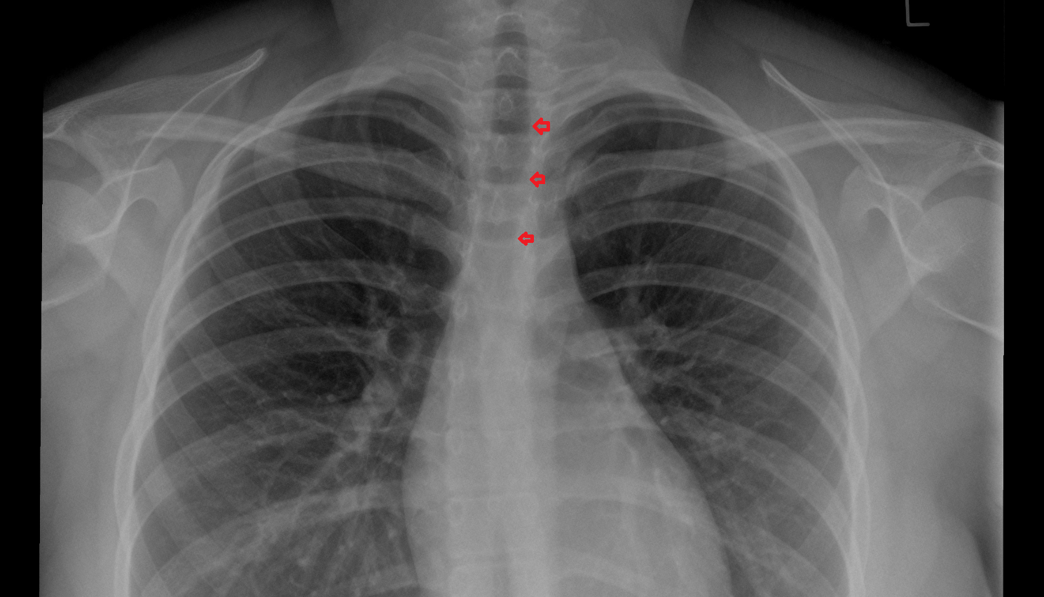 Left paratracheal stripe x ray  Anatomy, Location and Imaging Appearance CT anatomy image -img-00000-00000