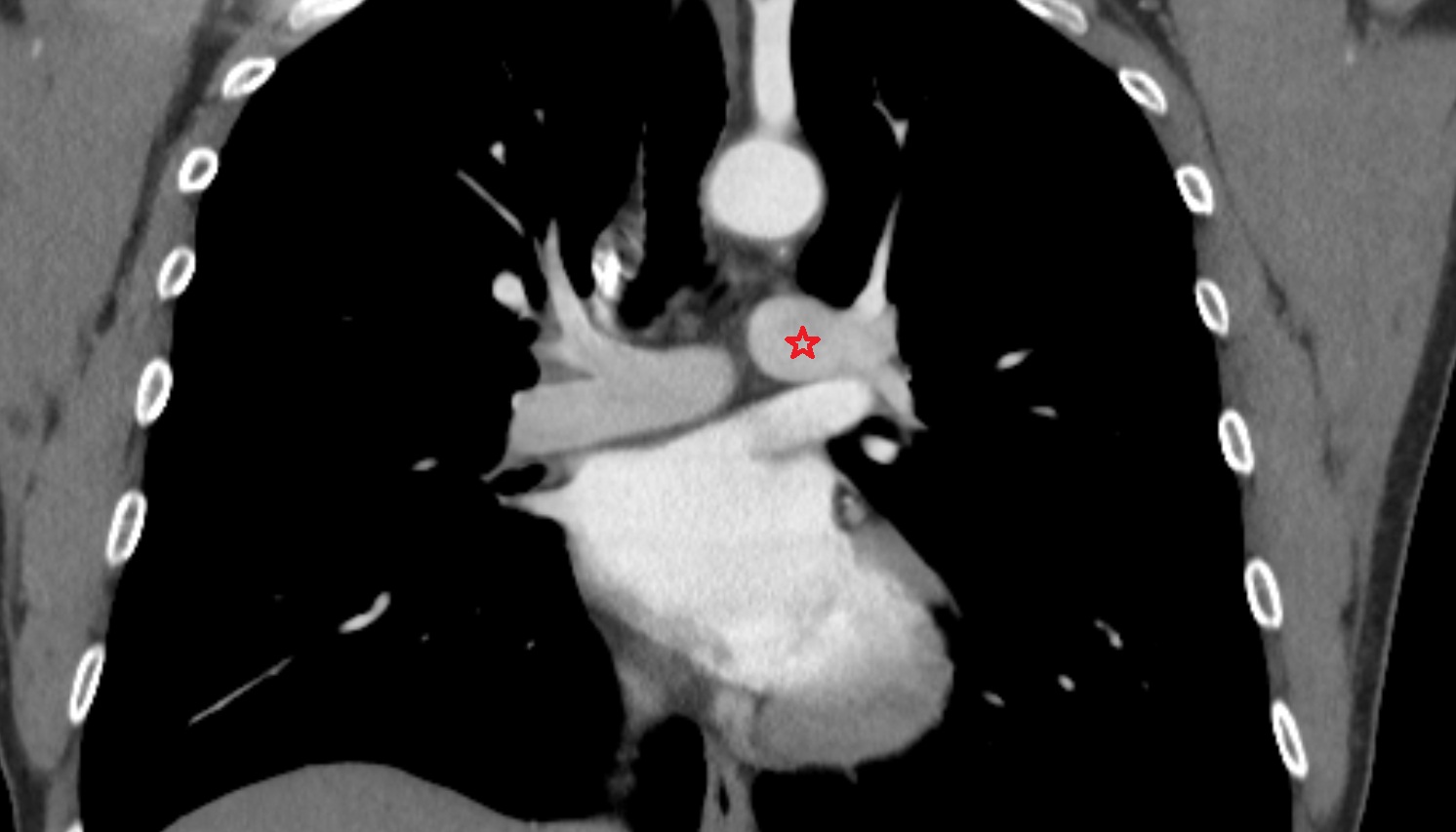 Left pulmonary artery  anatomy CT coronal  image -img-00000-00000