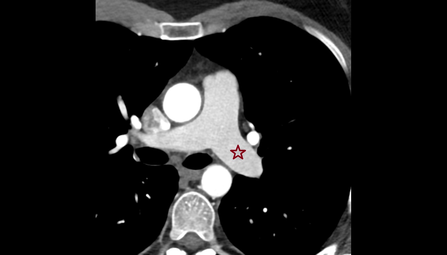 Left pulmonary artery  anatomyct axial  image -img-00000-00000